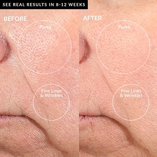 At-Home Microdermabrasion Machine for Face & Body with Exfoliating Crystals and Vacuum Suction W64080