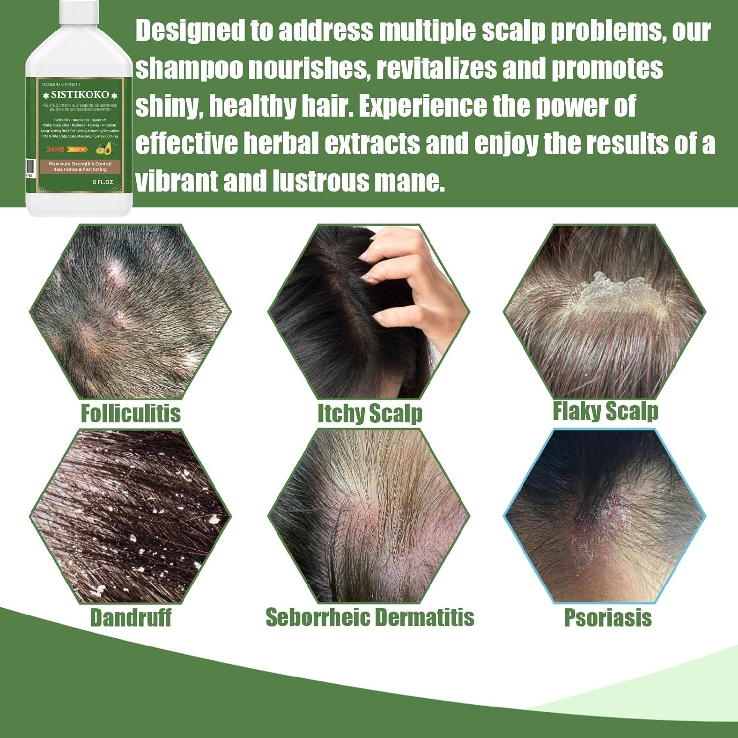 Folliculitis and Dandruff Shampoo for Itchy Scalp I698016