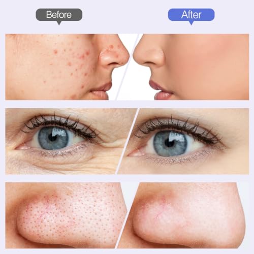 Microdermabrasion Machine Handheld Facial Tool for Home Use I747131